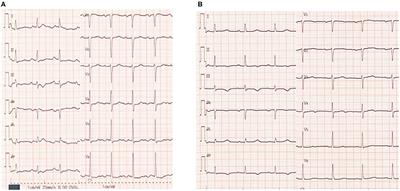 Case Report: QT Prolongation and Abortive Sudden Death Observed in an 85-Year-Old Female Patient With Advanced Lung Cancer Treated With Tyrosine Kinase Inhibitor Osimertinib